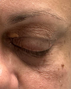 1_0002_patient 11 before xanthelasma excision.PNG