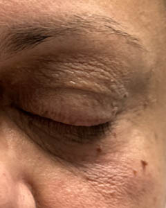 1_0003_patient 11 after xanthelasma excision.PNG