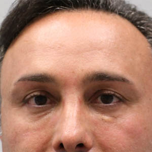 botox (1)