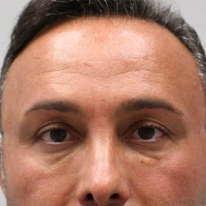botox (2)