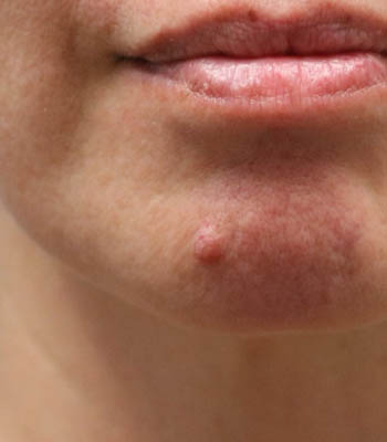 lesion1 (1)