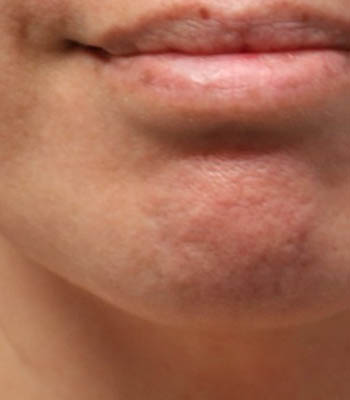 lesion1 (2)