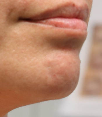 lesion1 (4)