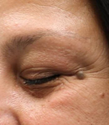 lesion3 (1)