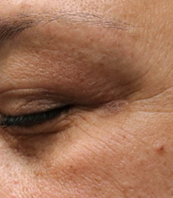 lesion3 (2)