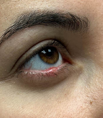 lesion4 (2)