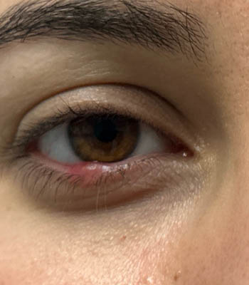 lesion4 (4)