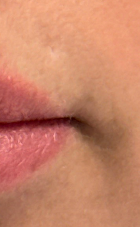 patient 1 after scar revision