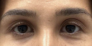 _0000_PT1-Before Lower Bleph- Eyes Only.jpg