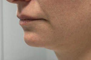 _0000_Patient 9 before chin and jawline filler 2.PNG