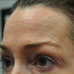 _0000_patient 2 before botox.PNG