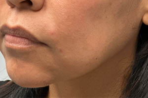 _0000_patient 2 before chin and jawline filler.PNG