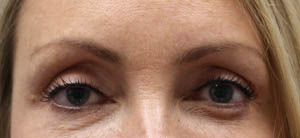_0000_patient 4 before left upper lid ptosis repair and subbrow filler.PNG