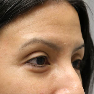 _0000_patient 5 before botox.PNG