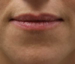 _0000_patient 6 before lip filler (front).PNG
