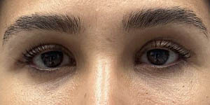 _0001_PT1-After Lower Bleph- Eyes Only.jpg