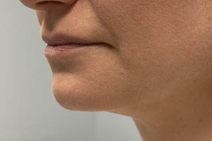 _0001_Patient 9 after chin and jawline filler 2.PNG