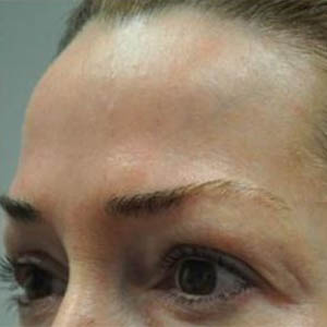 _0001_patient 2 after botox.PNG