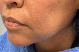_0001_patient 2 after chin and jawline filler.PNG