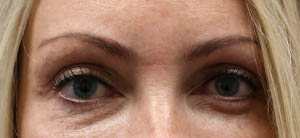 _0001_patient 4 after left upper lid ptosis repair and subbrow filler.PNG