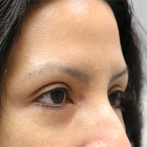 _0001_patient 5 after botox -.PNG