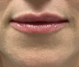 _0001_patient 6 after lip filler (front).PNG