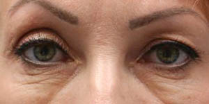 _0002_PT4-Before Lower Bleph- Dissolving 3 – Eyes Only.jpg