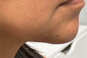 _0002_patient 3 before chin and jawline filler.PNG