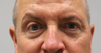 _0002_patient 4 before botox.PNG