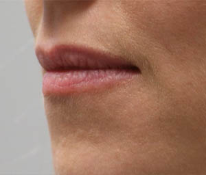 _0002_patient 6 before lip filler (side).PNG