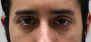 _0002_patient 6 before ptosis repair.PNG