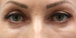 _0003_PT4-After Lower Bleph- Eyes Only.jpg