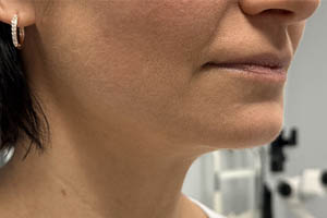 _0003_Patient 9 after chin and jawline filler.PNG