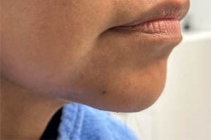_0003_patient 3 after chin and jawline filler.PNG