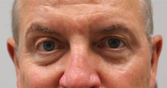_0003_patient 4 after botox.PNG