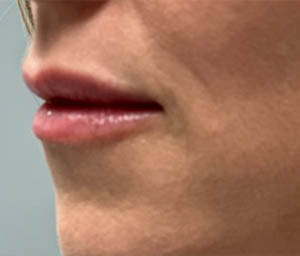 _0003_patient 6 after lip filler (side).PNG