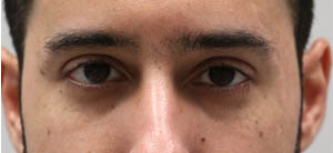 _0003_patient 6 after ptosis repair.PNG