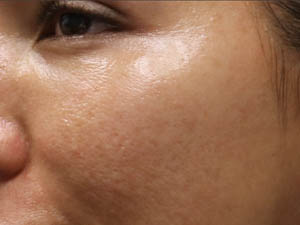 _0003_patient 8 after morpheus – Copy.PNG