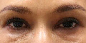 _0004_PT7- before lower eyes.jpg