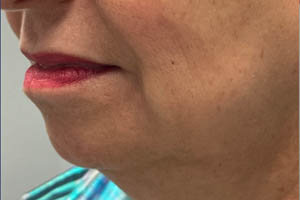 _0004_Patient 10 before chin filler.PNG