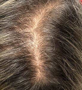 _0004_patient 2 before exosomes for hair.PNG