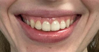 _0004_patient 3 before botox for gummy smile.PNG