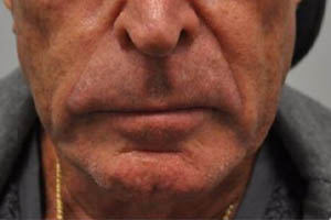 _0004_patient 4 before chin and jawline filler.PNG
