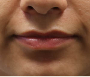 _0004_patient 7 before lip filler (front).PNG