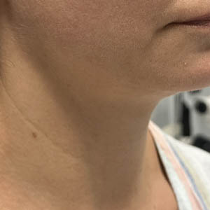 _0004_patient 7 before neck botox.PNG