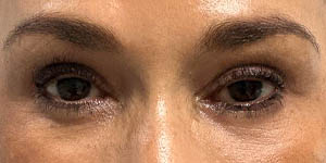 _0005_PT7- After Lower eyes.jpg