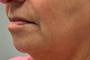 _0005_Patient 10 after chin filler.PNG