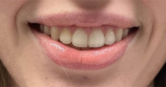 _0005_patient 3 after botox for gummy smile.PNG