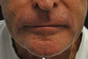 _0005_patient 4 after chin and jawline filler.PNG