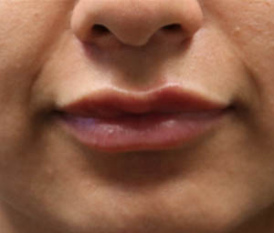 _0005_patient 7 after lip filler (after).PNG